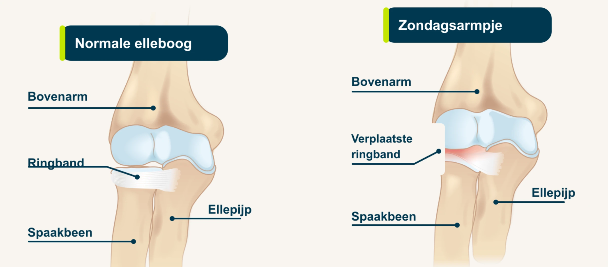 Medische illustratie met links een normale kinderelleboog en rechts een zondagsarmpje met verschoven ringband